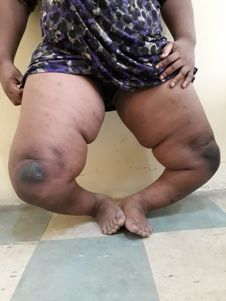 Before: Severe Bilateral Genu Varum / Blount's Disease